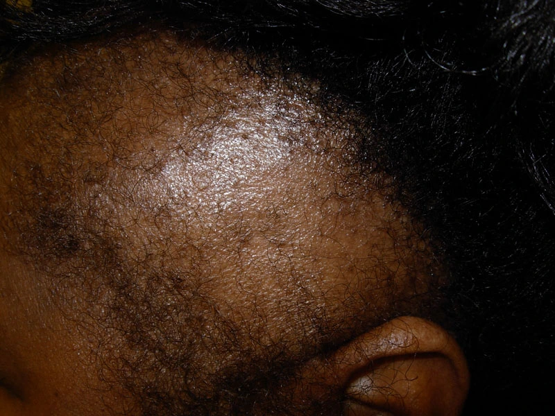 Bald spot on women's had