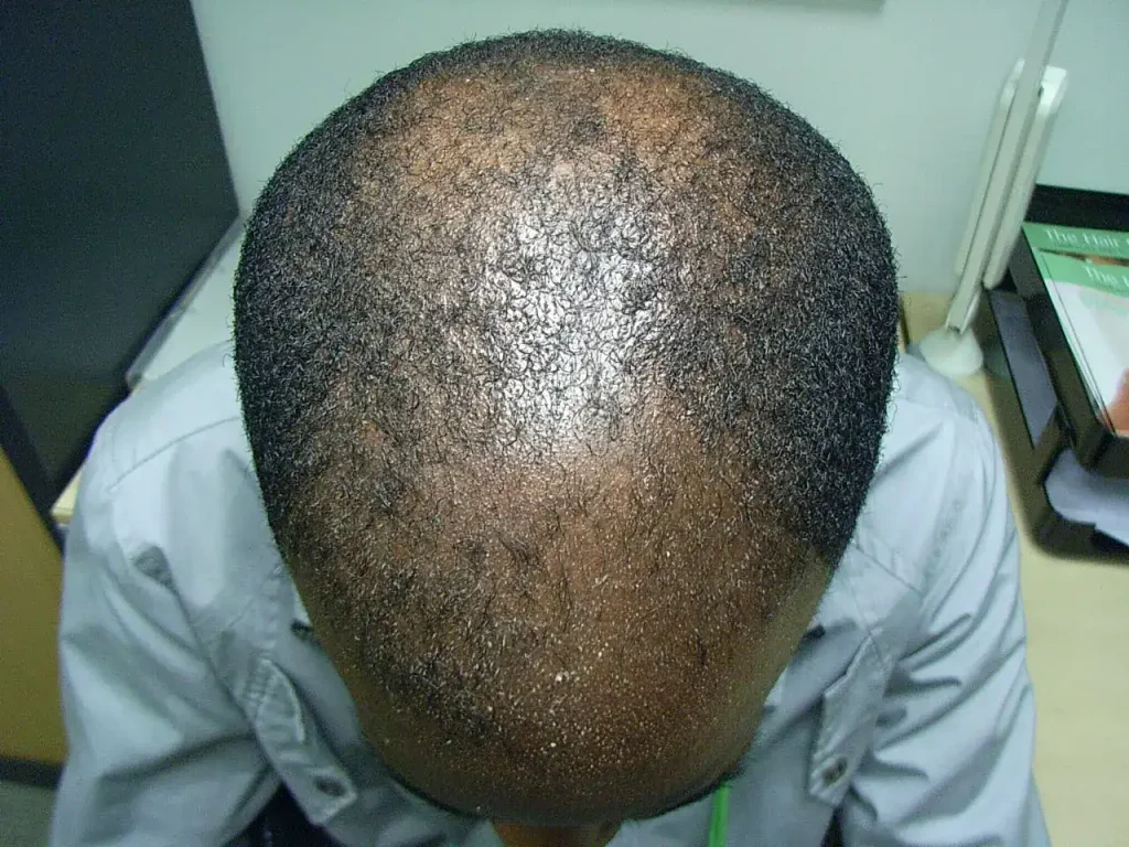 A black man's head, shot from the top to show his thinning hair