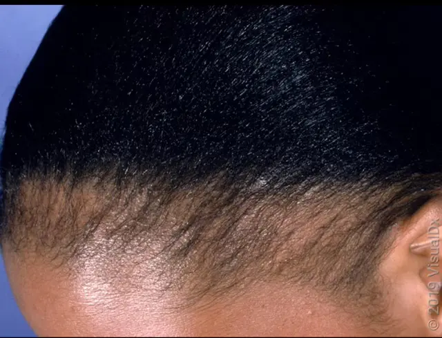 A woman's head with hair loss on the edges