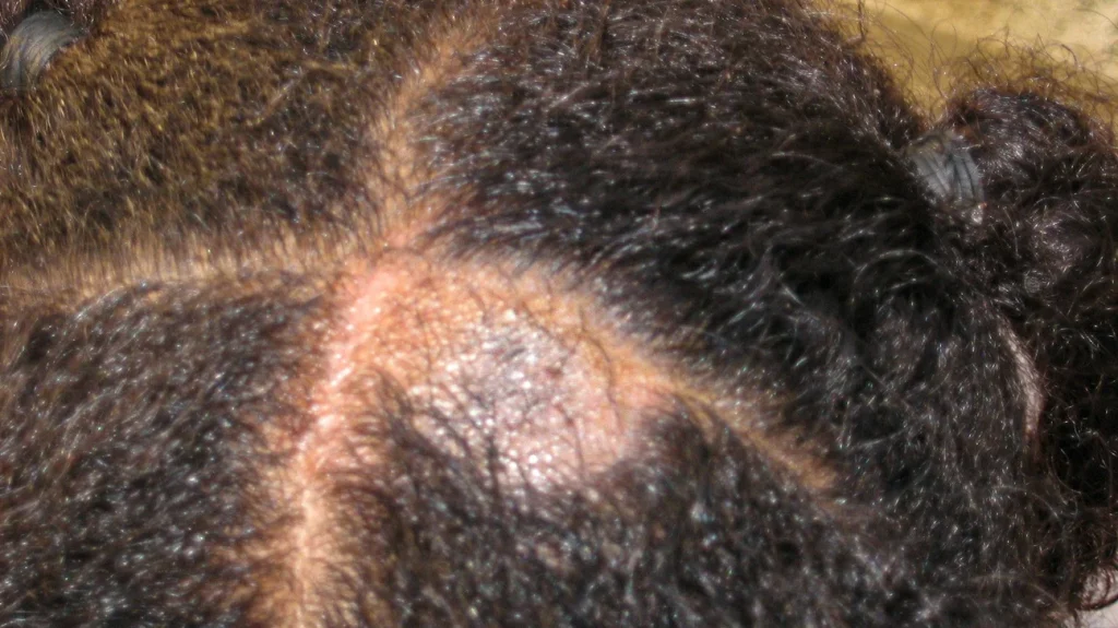 A coin-sized bald spot on a black woman's head